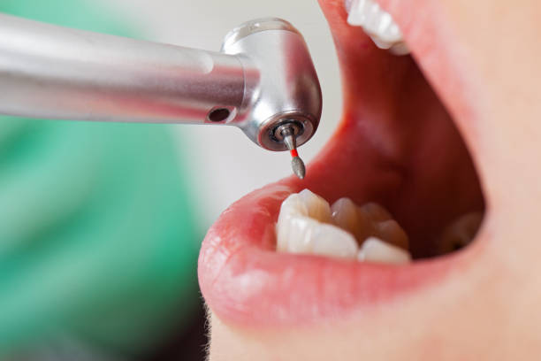Best Emergency Treatment for Dental Infections or Abscesses in Boonville, NC